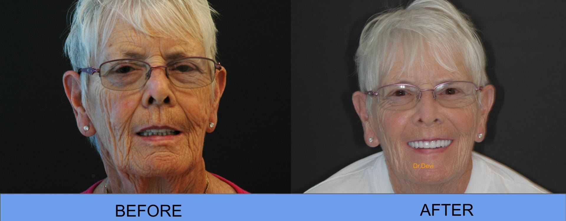 Before and After — All-on-4® Patient
