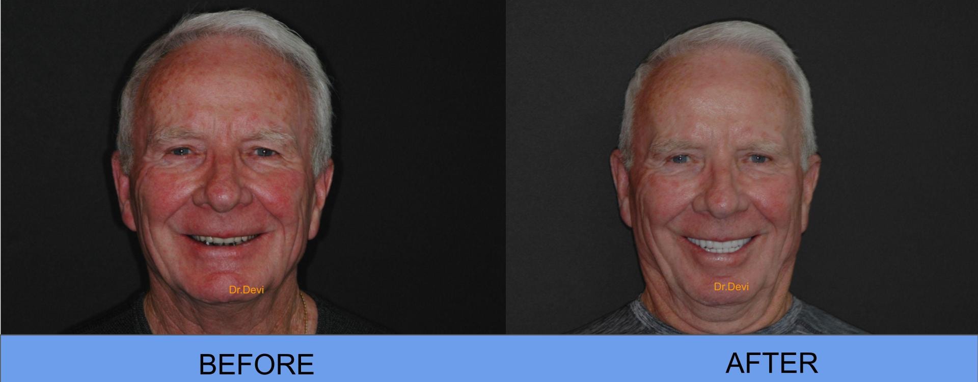 Before and After — All-on-4® Patient