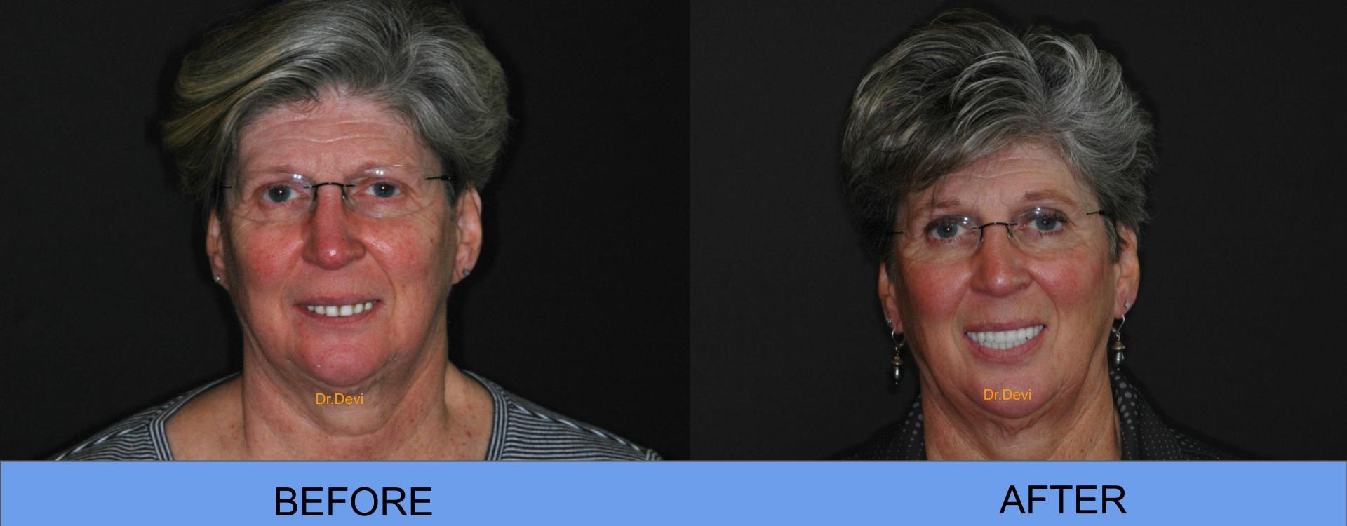 Before and After — All-on-4® Patient