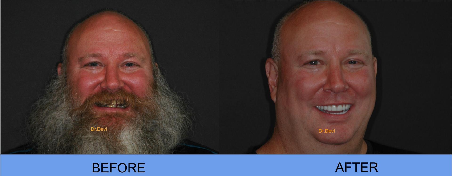 Before and After — All-on-4® Patient Tom