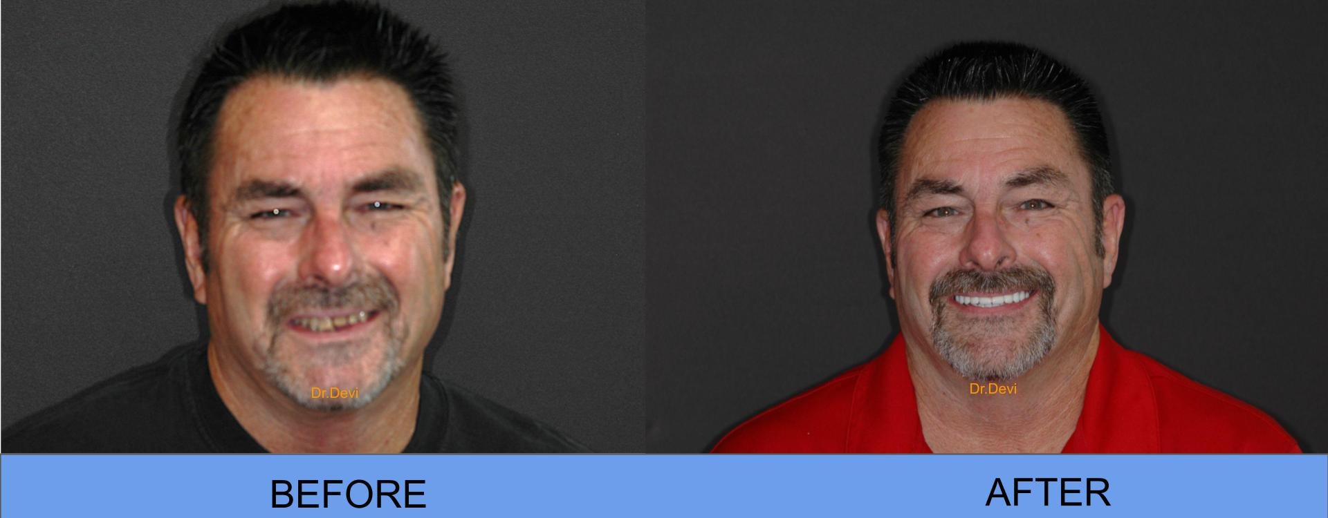 Before and After — All-on-4® Patient Ed