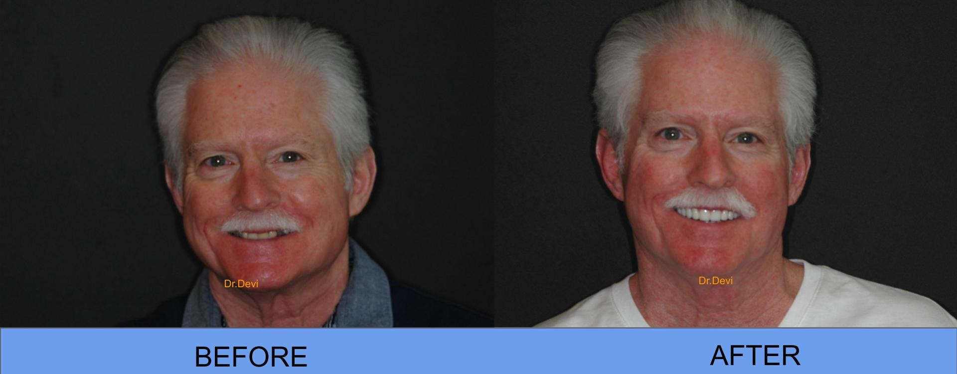 Before and After — All-on-4® Patient